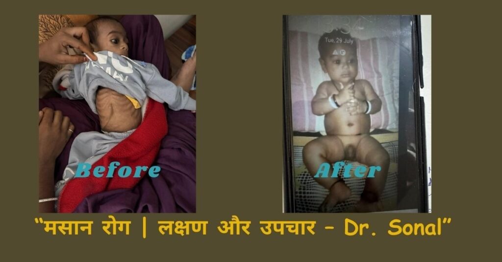 “मसान बिमारी के लक्षण और उपचार – Dr. Sonal” डालो