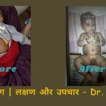 “मसान बिमारी के लक्षण और उपचार – Dr. Sonal” डालो