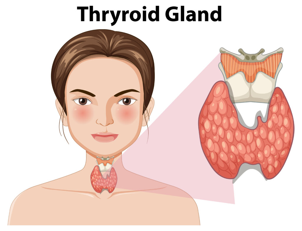 Treatment of Thyroid by dr sonal dhull